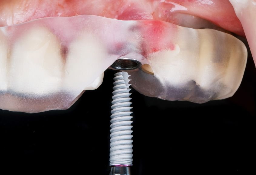 implante-dental-unitario-en-ciudad-lineal-madrid