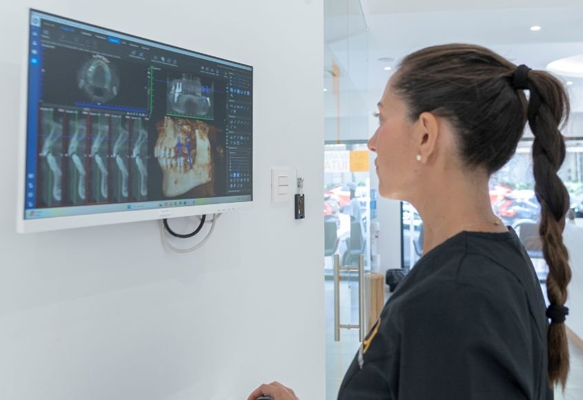 implantes-dentales-corticales-en-madrid