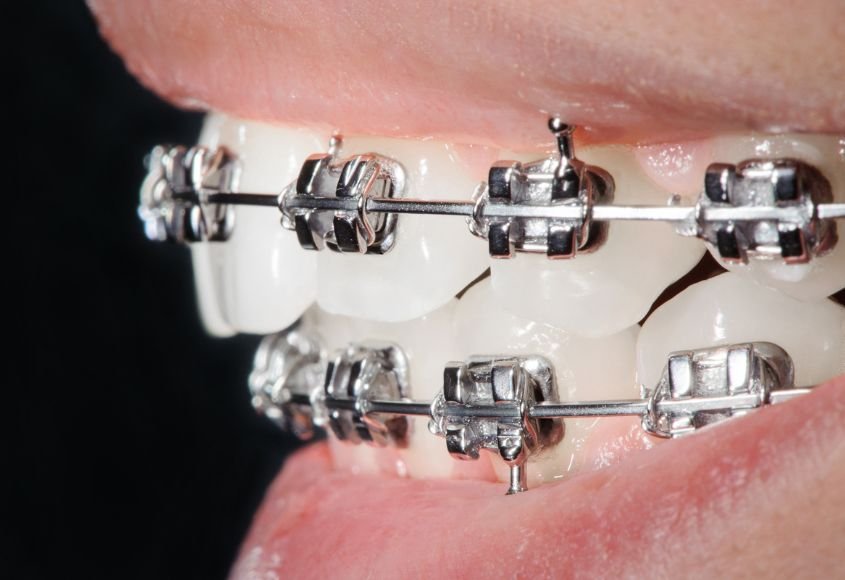 ortodoncia-brackets-metalicos-madrid-ciudad-lineal