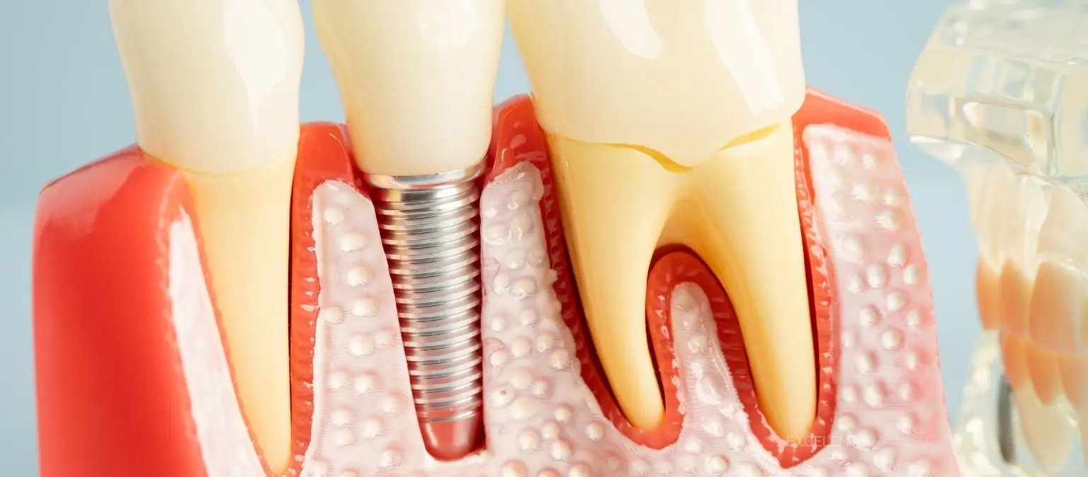 Implantes dentales en clínica dental Excelentia