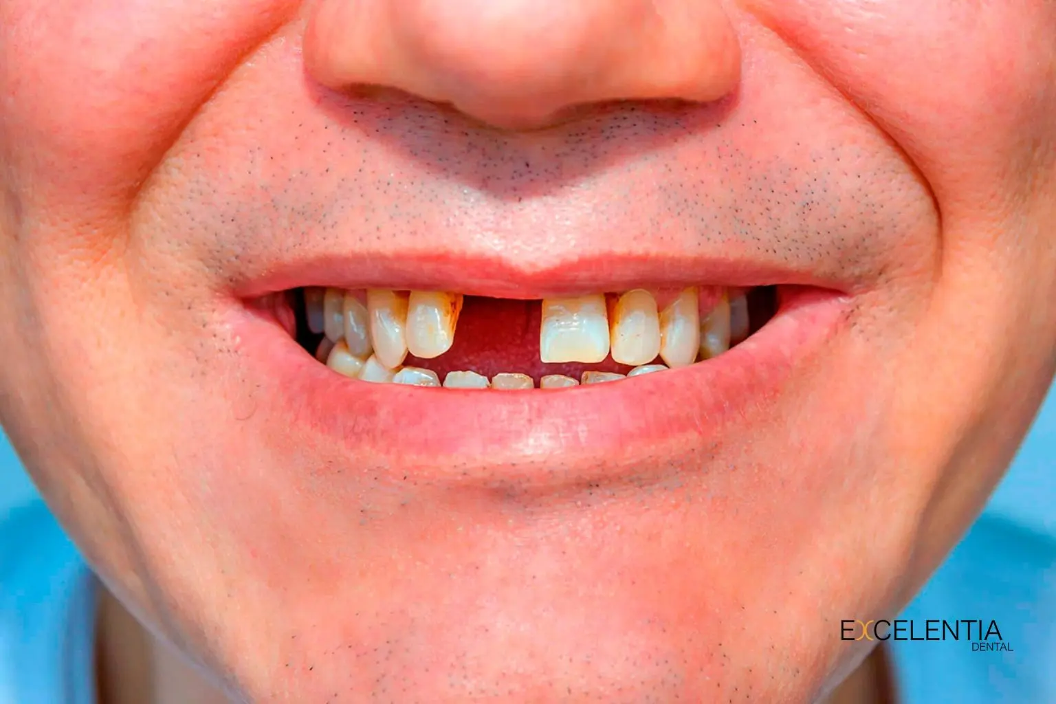 Pérdida de implantes dentales en Ciudad Lineal (Madrid) Clinica Dental Excelentia Dental