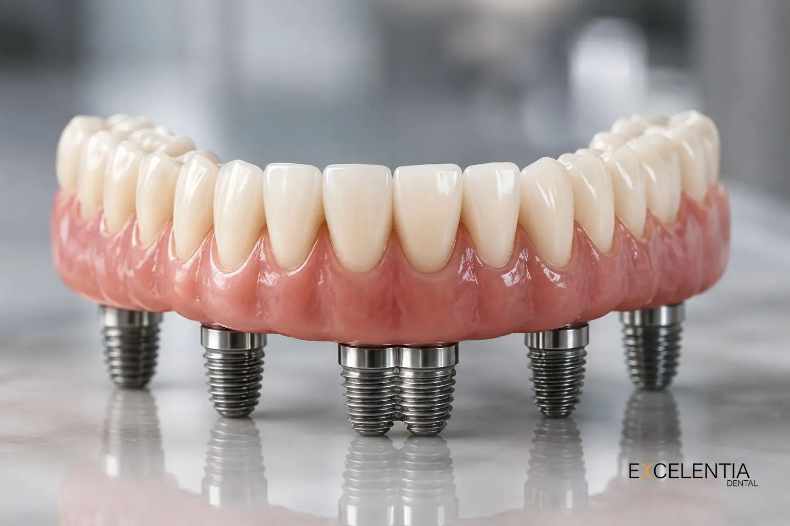 Rehbilitación fija completa en Ciudad Lineal (Madrid) Clinica Dental Excelentia