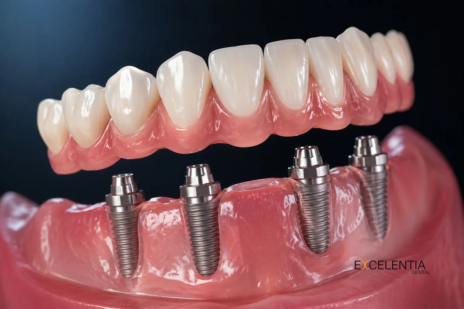 Implantes de carga inmediata Clinica Dental Excelentia en Ciudad Lienal (Madrid)