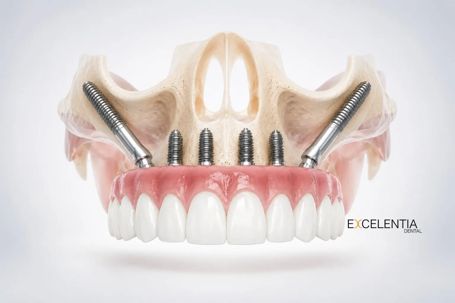 Implantes cigomáticos en Ciudad Lineal (Madrid) Excelentia Dental