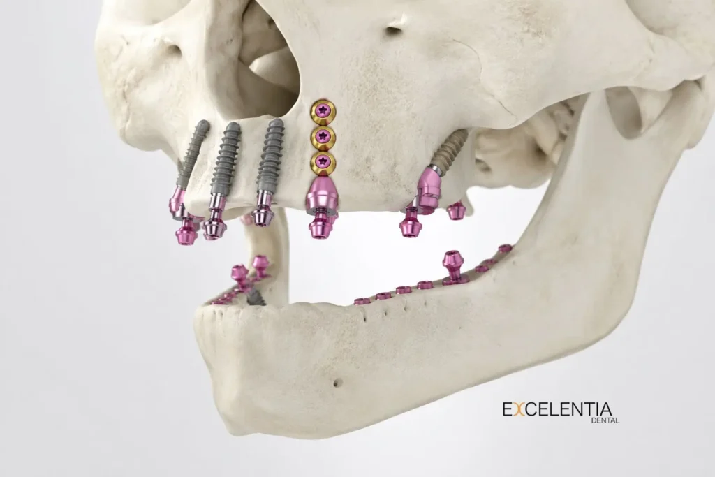 Implantes corticales en Excelentia Dental (Madrid)